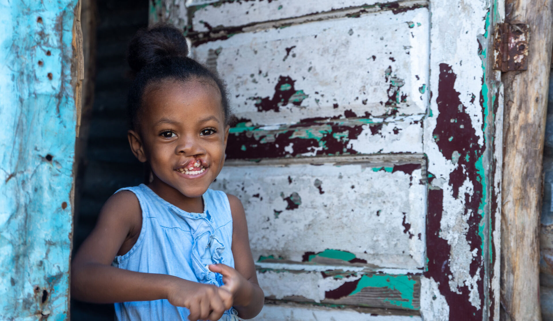 Young girl with cleft lip watches the camera from the entrance to her home.