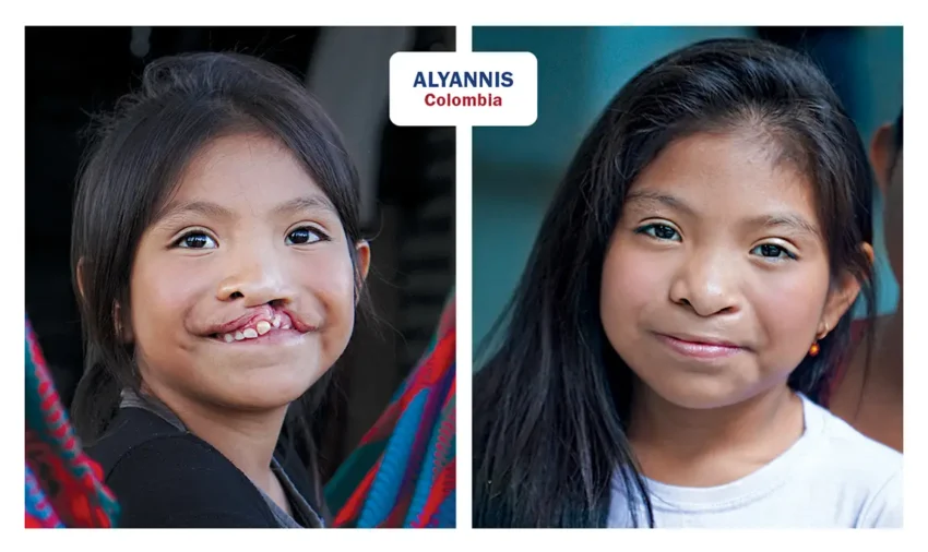 Photos of Alyannis from Colombia, before and after her surgery