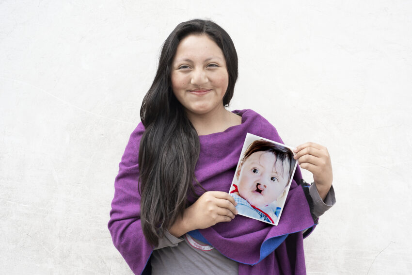 Young woman holds a photo of herself as a young child with cleft lip.