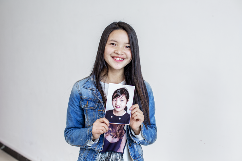 Teenage girl holding photo of her younger self before she received cleft surgery