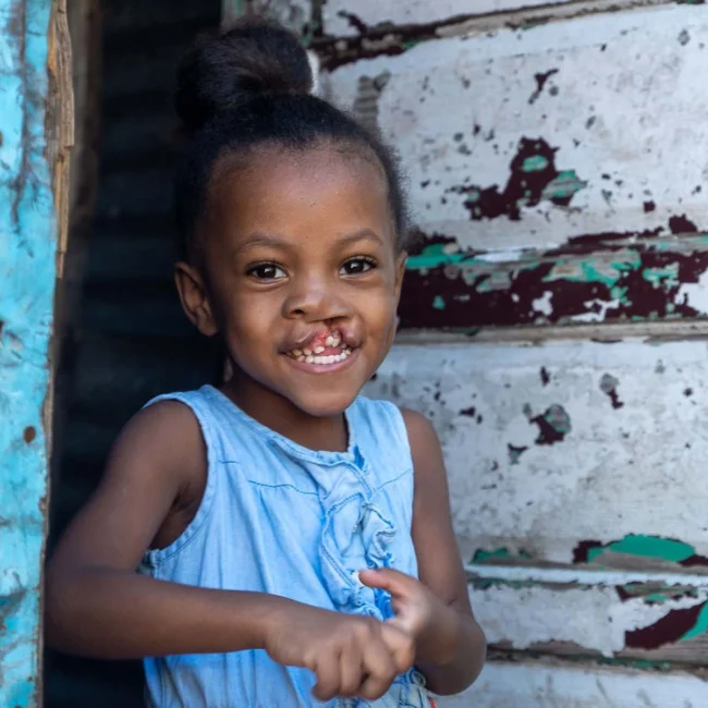 Daniela, before surgery, Dominican Republic