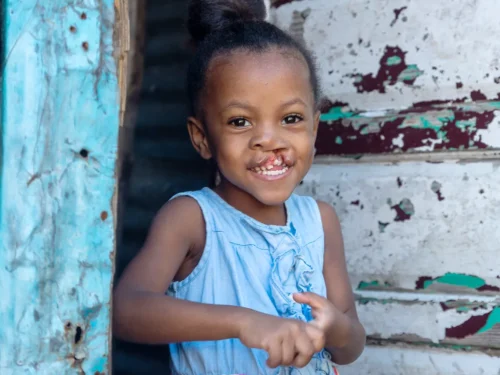 Daniella, age 4, from Dominican Republic, before surgery