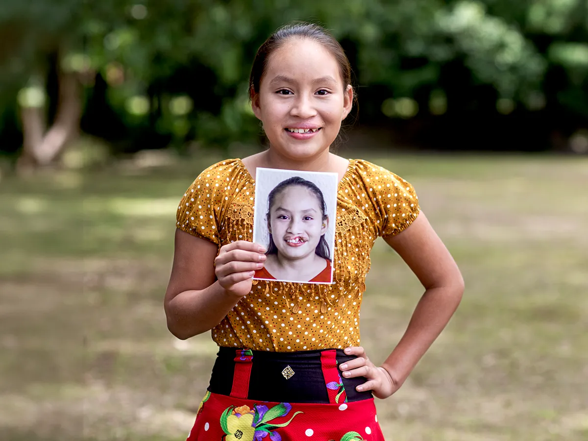 Dayana Aracely from Quatemala holding a photo of her before her surgery