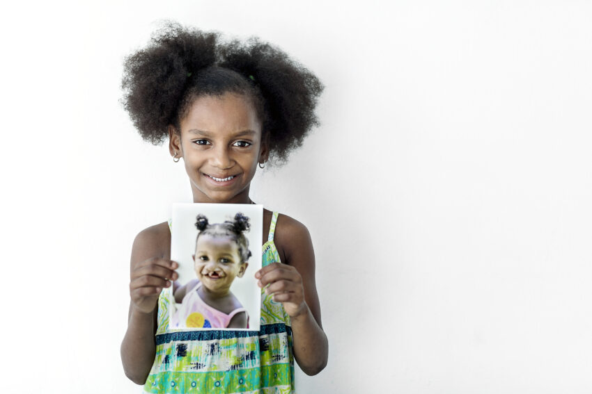 Young girl smiling while holding up a photo of her younger self before receiving cleft surgery