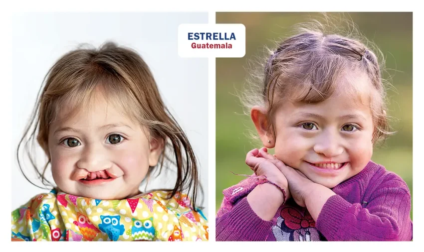 Photos of Estrella from Guatemala, before and after her surgery