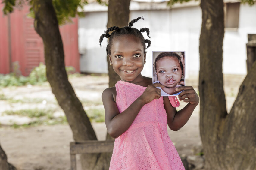 Young girl wearing pink dress smiling while holding photo of herself before receiving cleft lip surgery.