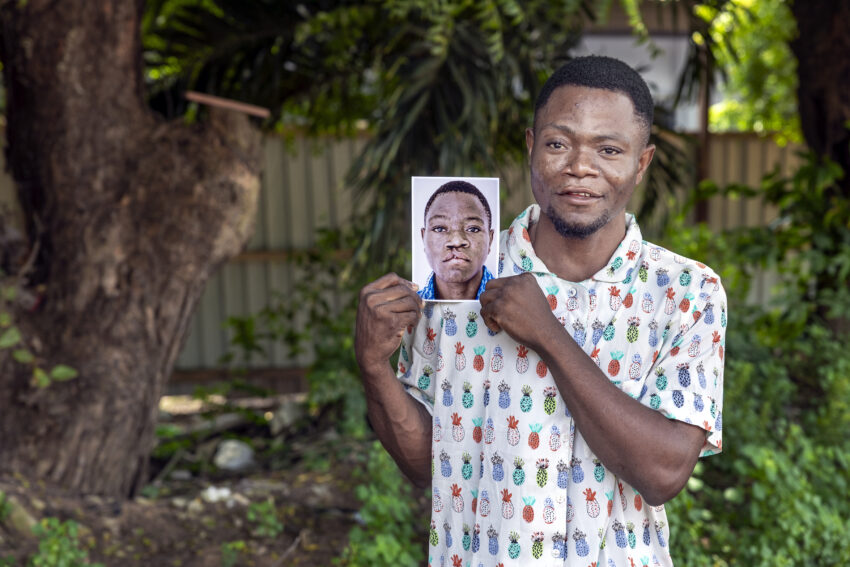 Man holding photo of his younger self before receiving cleft surgery