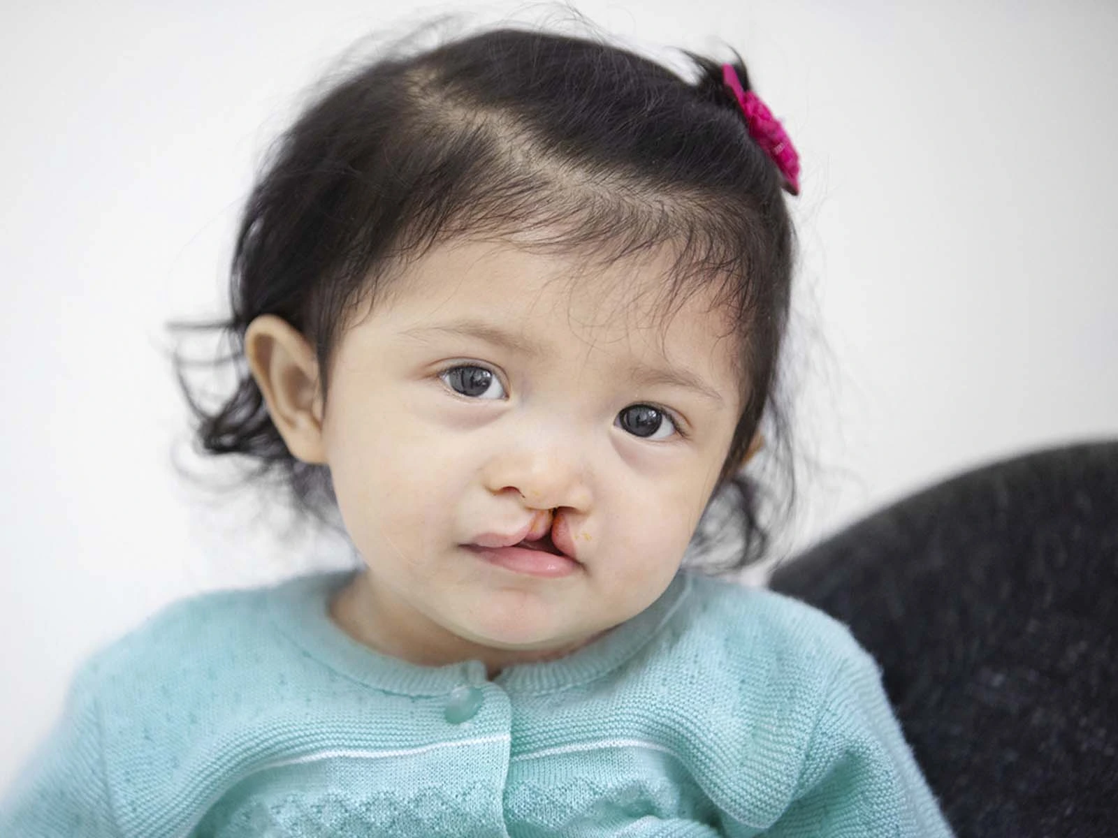 Fatima from Guatemala before surgery