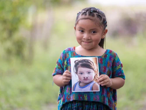 Young girl wearing a brightly coloured shirt, holding a photo of younger self before cleft surgery, showing her bilateral cleft lip.
