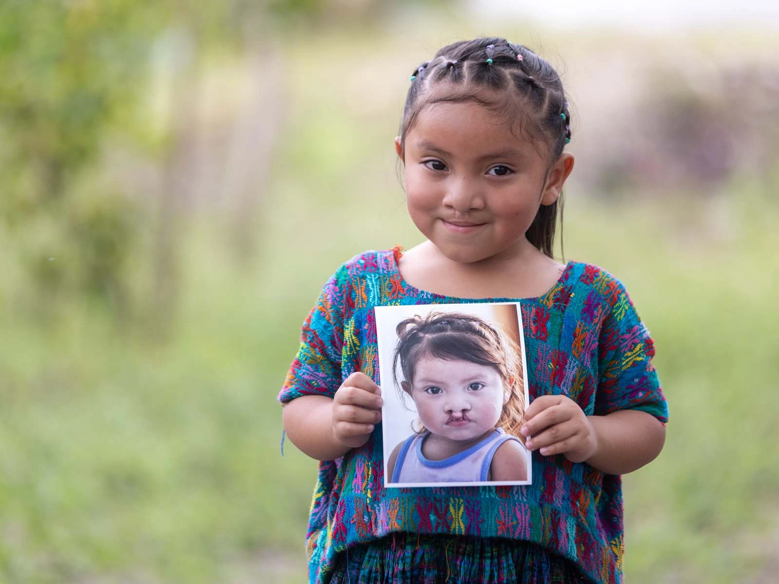 Young girl wearing a brightly coloured shirt, holding a photo of younger self before cleft surgery, showing her bilateral cleft lip.
