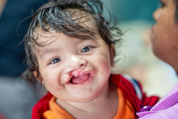 Alexis Ezequiel Turcios Godoy, 7 months, male, UCL, before, during screening during the Operation Smile mission at the Hospital General San Felipe in Tegucigalpa, Honduras February 18, 2016.