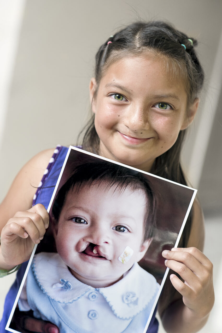 Young girl shows photo of her younger self before she received cleft surgery.