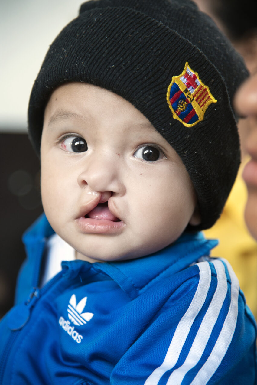 Young child with cleft lip wearing a black toque and blue Adidas zip-up looks at the camera.