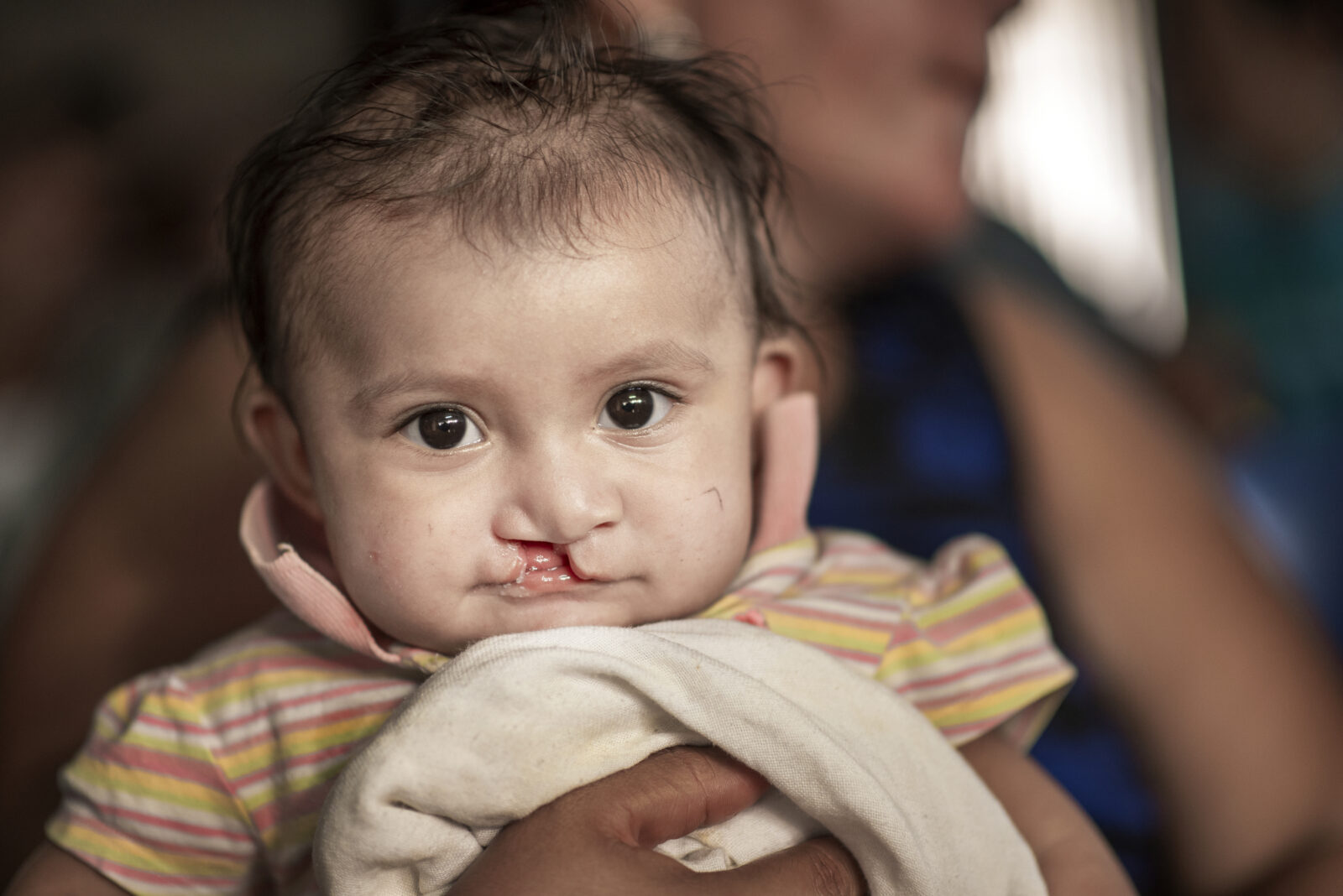 Child with cleft lip being held by their mother.