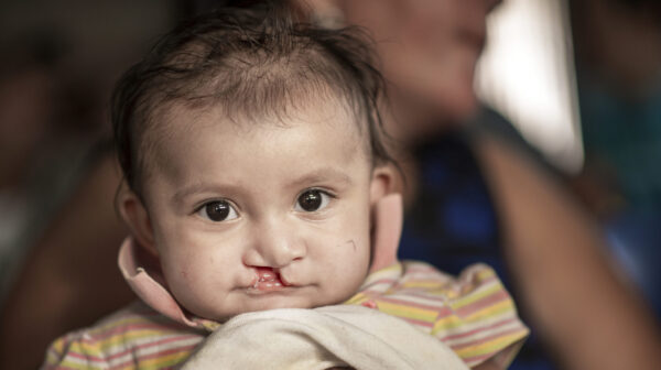 Child with cleft lip being held by their mother.