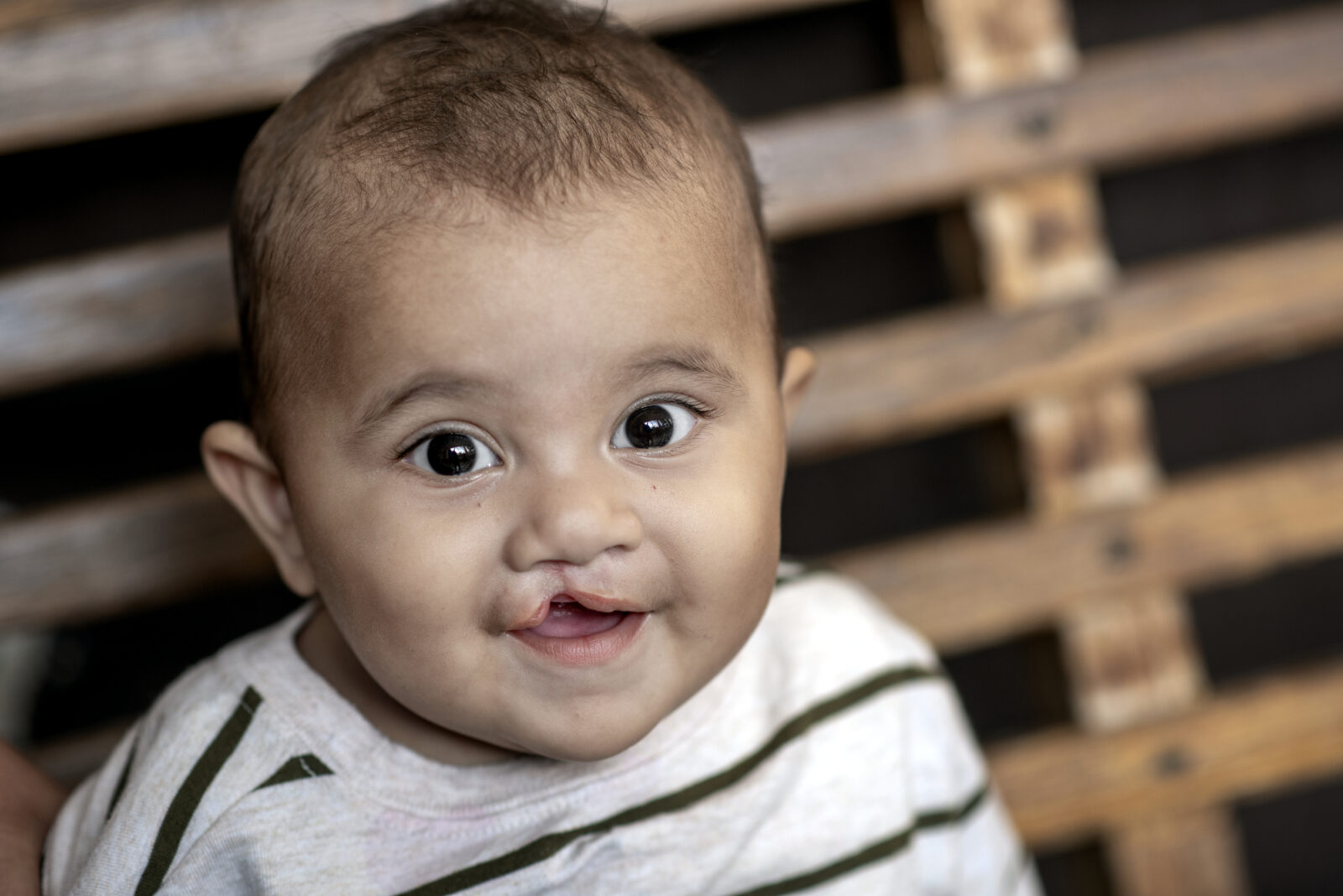 A bright-eyed boy with a cleft lip looks at the camera and smiles