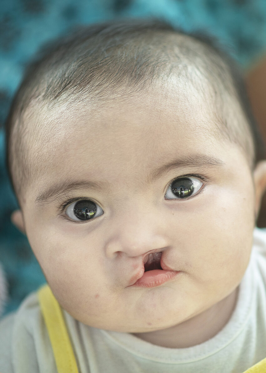 An infant with a cleft lip looks at the camera