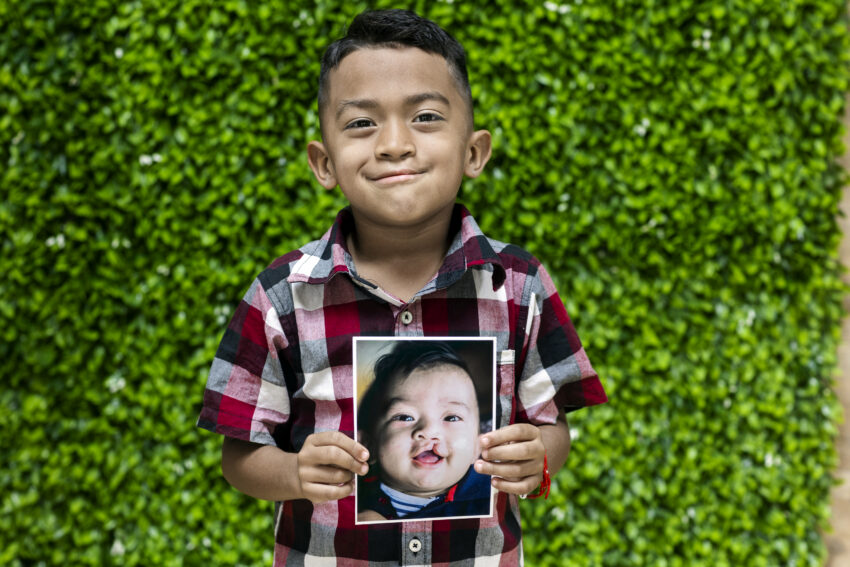 Boy smiles towards camera as he holds photo of his younger self before he received cleft surgery.