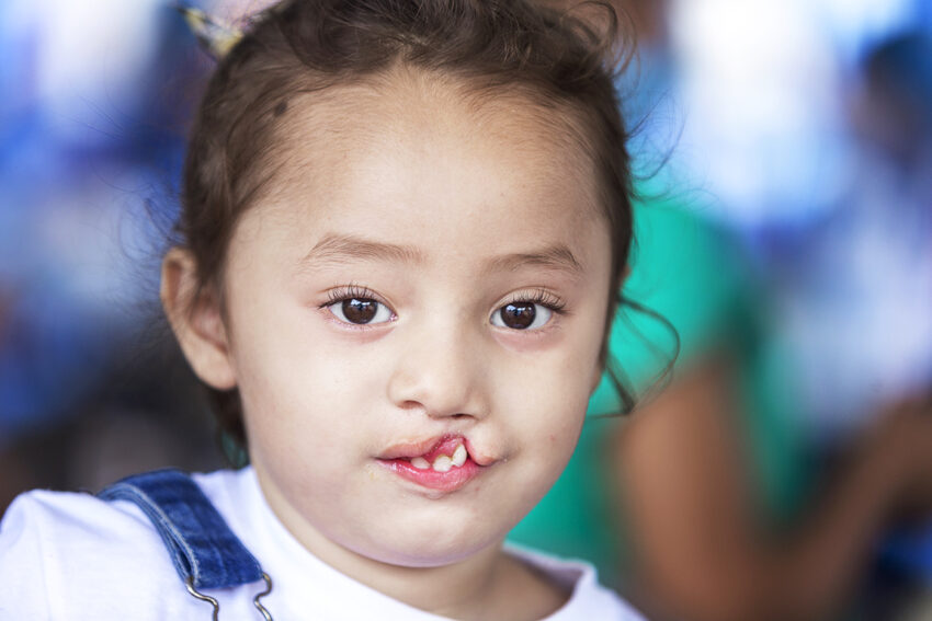 A young girl with a cleft lip smiling.