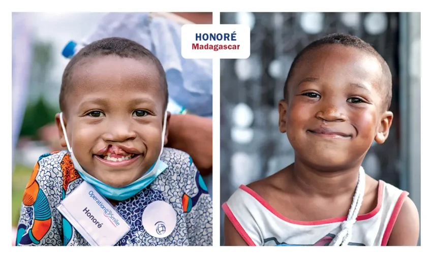 Honore from Madagascar, before and after his surgery