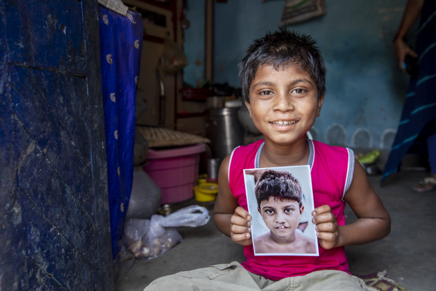 Boy sitting holds photo of his younger self before receiving cleft surgery.