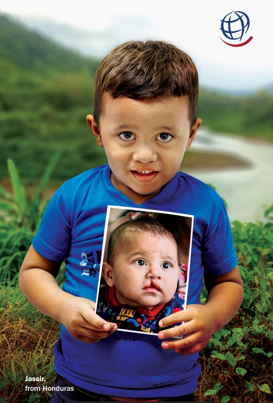 A young boy smiles as he holds a picture of himself as a baby with a cleft lip