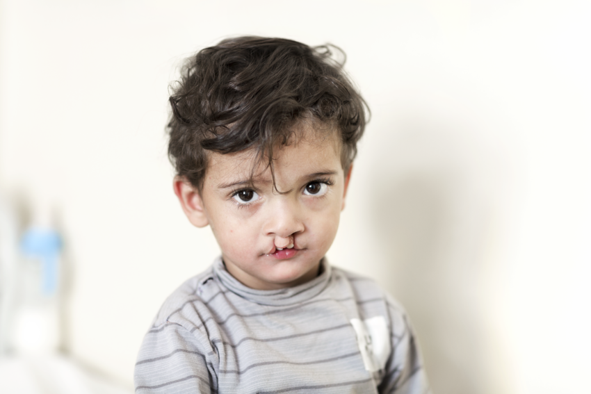 Young boy with white background who has a cleft condition.