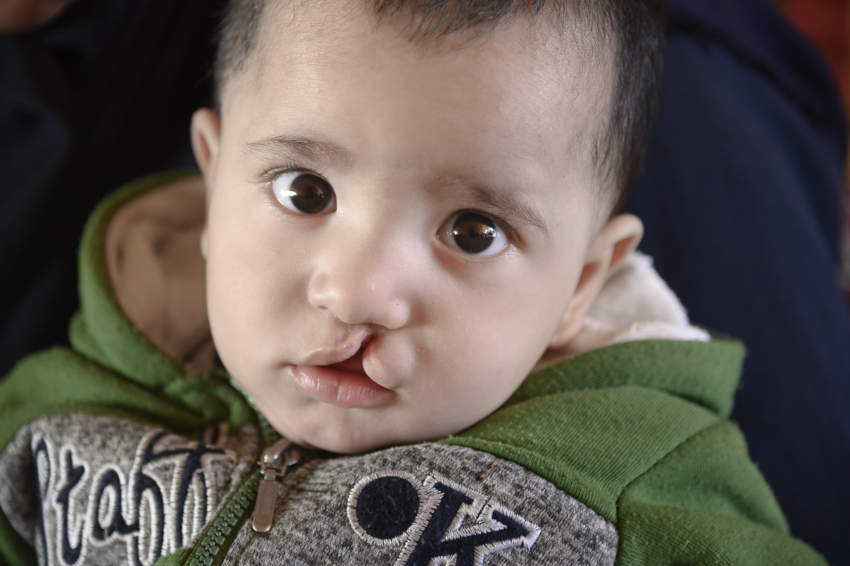 Infant with cleft condition looking towards camera