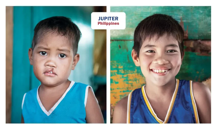 Photos of Jupiter from the Phillippines, before and after her surgery