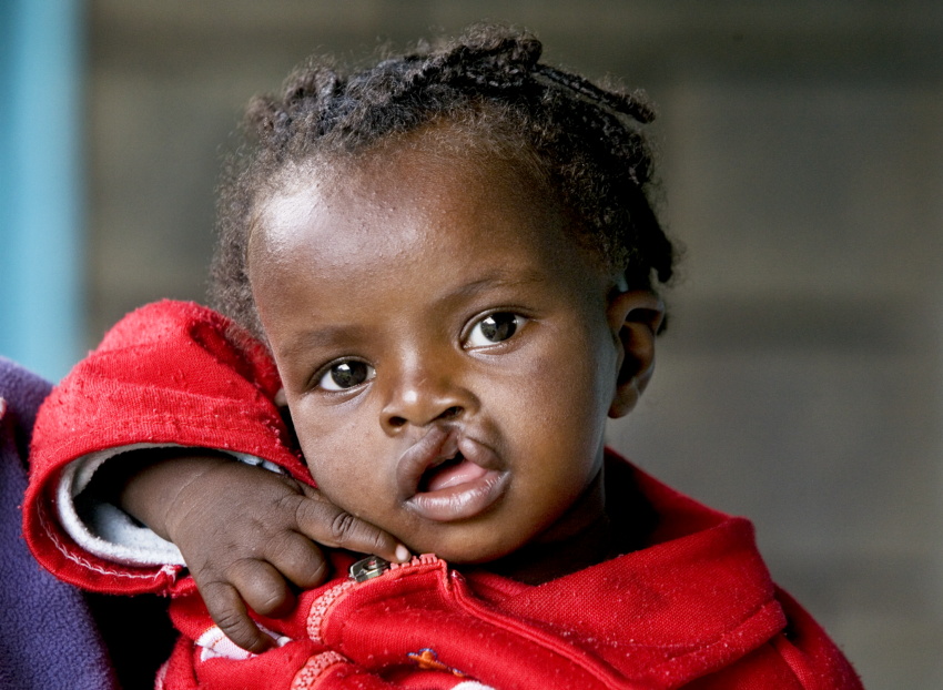 Young girl wearing a red sweater who has a cleft condition.