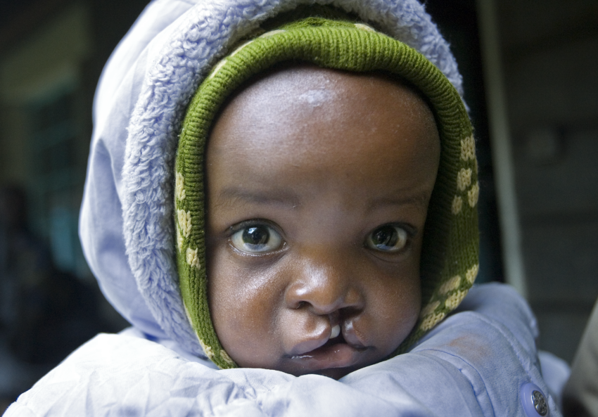 A young boy wearing a grey sweater and hoodie with a cleft condition