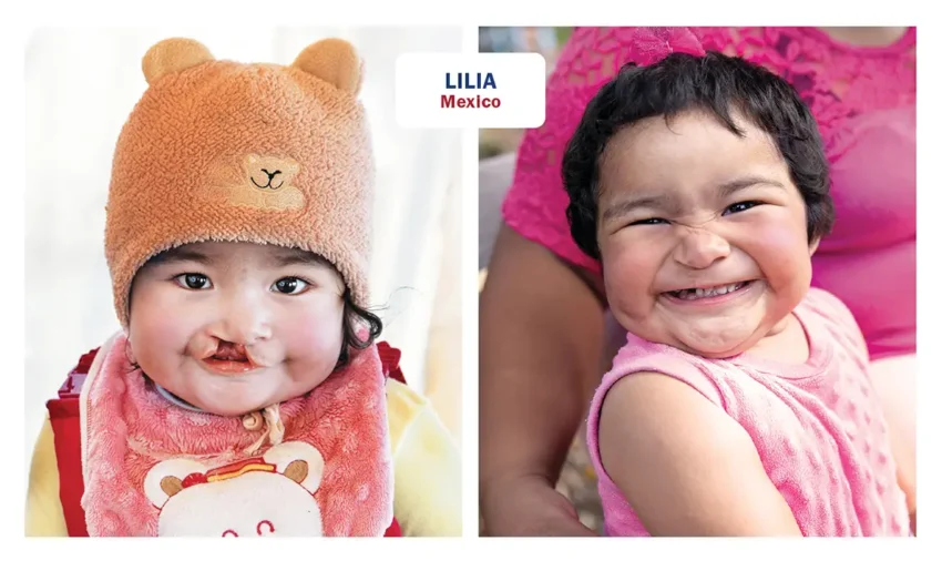Photos of Lilia from Mexico, before and after her surgery