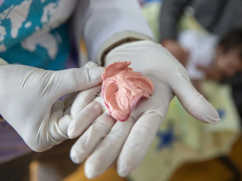 Palate mold being held by dentist