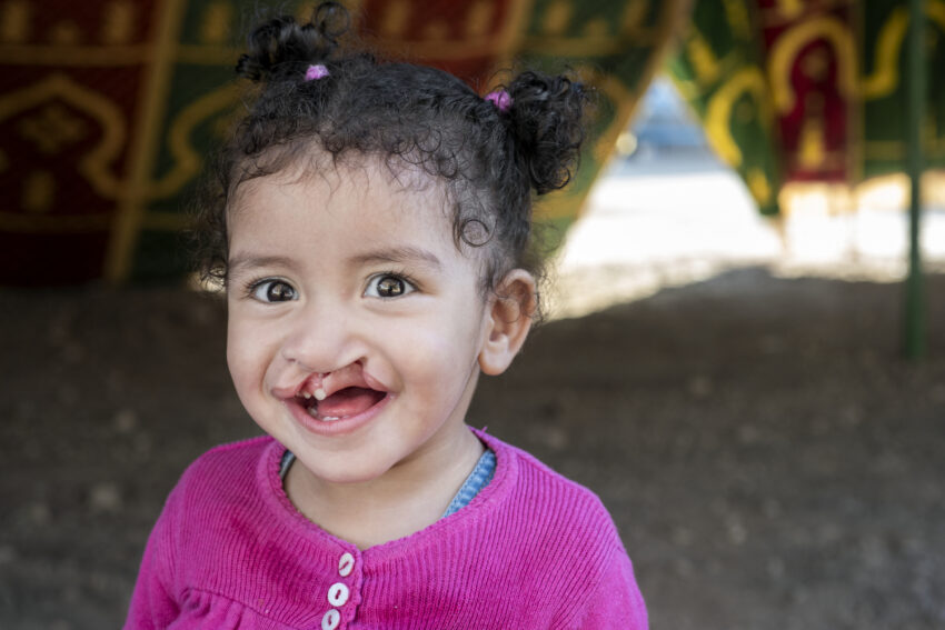 Young girl with cleft lip is wearing a bright pink sweater, standing outside.