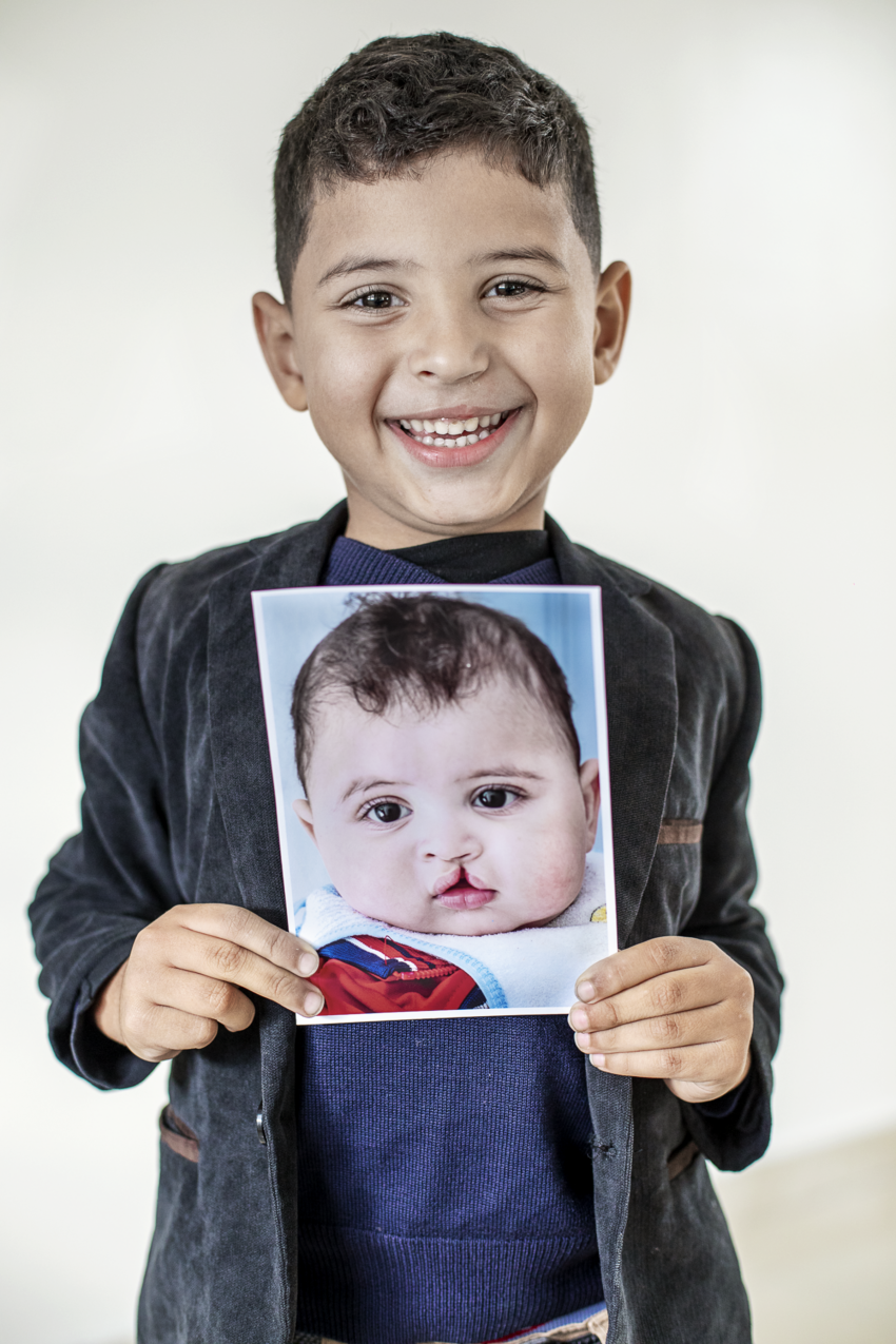 Boy holding photo of his younger self before he received cleft surgery