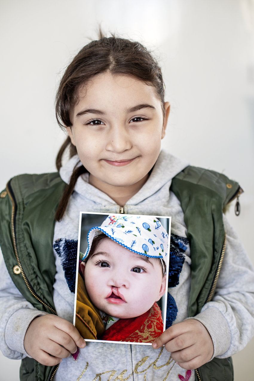 Teenage girl holding photo of her younger self before she received cleft surgery