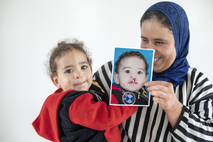 Three-year old girl and her mom holding photo of her younger self before she received cleft surgery