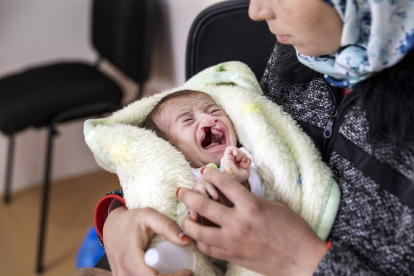 A baby with a cleft lip cries while being held by a woman 