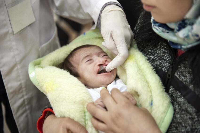 A baby is held by a woman while a doctor with a white glove inserts a molded device into her mouth that closes the cleft lip gap.