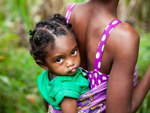 Arimalala Nambina, 2 years old, Unilateral Cleft lip, Before. Mother: Rosoa Arimalala Aunorine