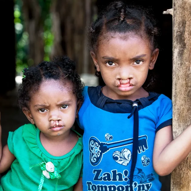 Arimalala Nambina, 2 years old, Unilateral Cleft lip, Before. Oldest Daughter: Vaviroa Lalatianan, 6 years old. Bilateral Cleft lip, before