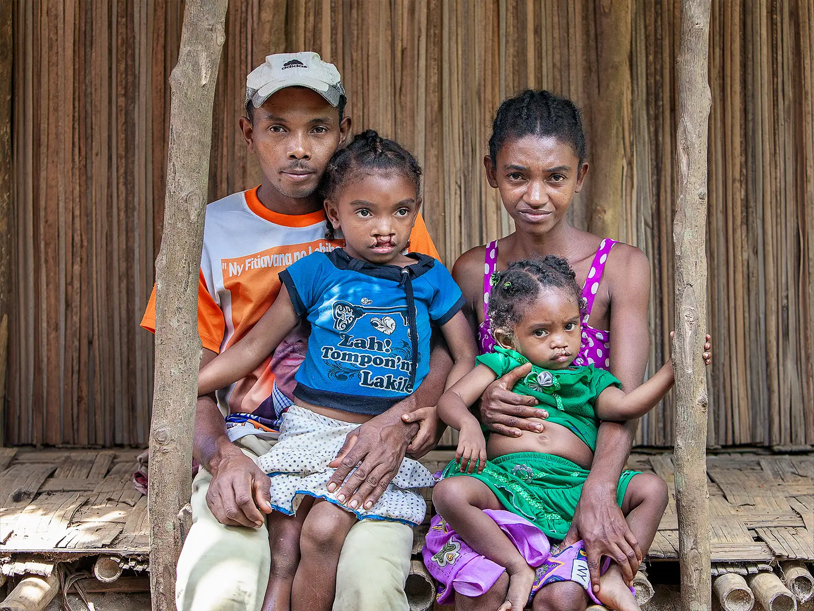 Photo Shows: Father: Dest Velontsoa Oldest Daughter: Vaviroa Lalatianan, 6 years old. Bilateral Cleft lip, before. Youngest Daughter: Arimalala Nambina, 2 years old, Unilateral Cleft lip, Before. Mother: Rosoa Arimalala Aunorine