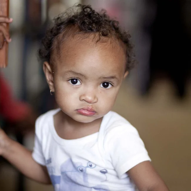 Joyce has returned to Operation Smile Madagascar for her cleft palate surgery.
