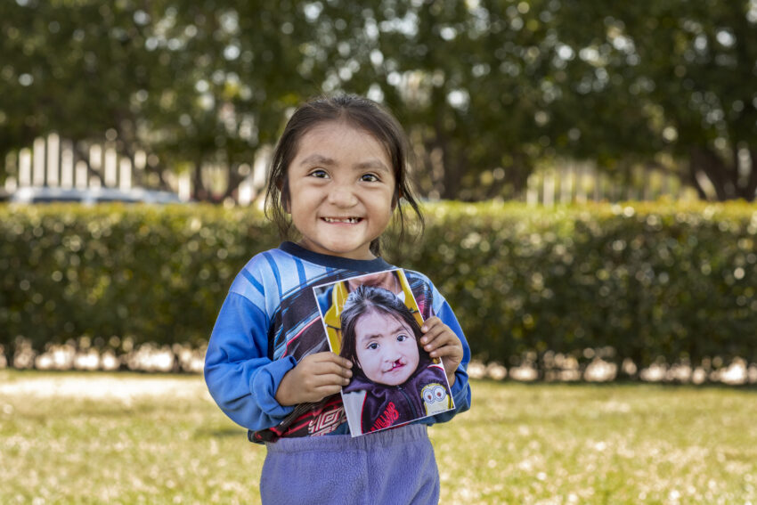 girl holding photo of her younger self before she received cleft surgery