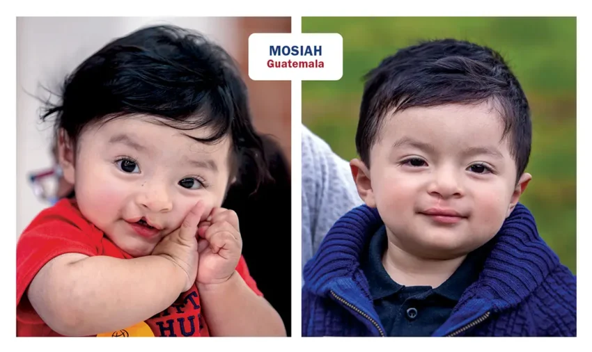 Photos of Mosiah from Guatemala, before and after his surgery