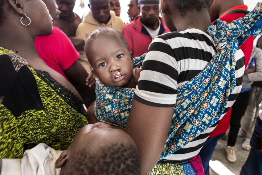 baby born with cleft conditions looking straight into the camera