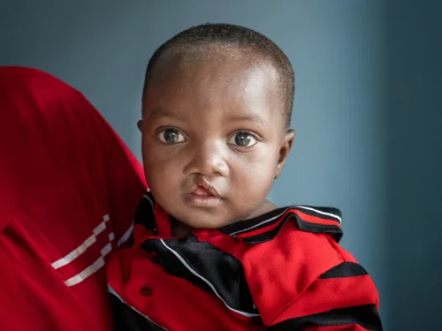 Tumpale Nyondo, Male, 1 Year Old, Cleft UCL, Baby, Before, Portrait. Operation Smile Mission, Lilongwe, Malawi - Kamuzu Central Hospital