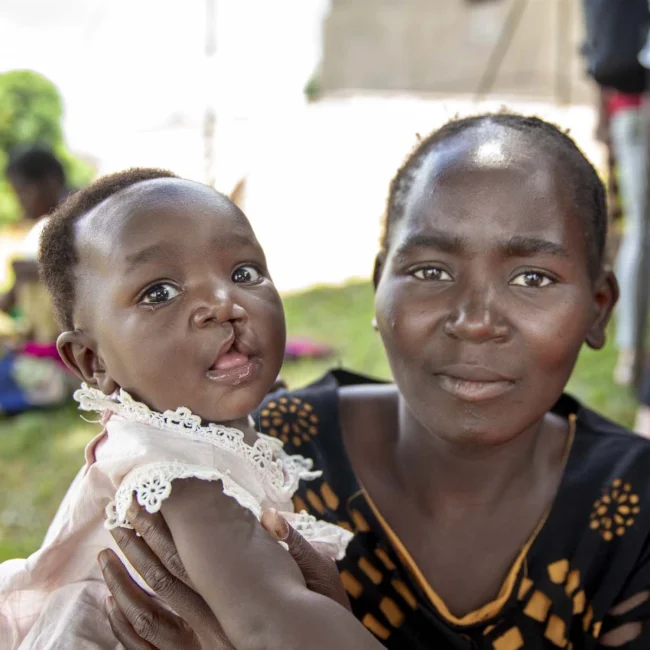 Rute is a patient of Operation Smile in Malawi