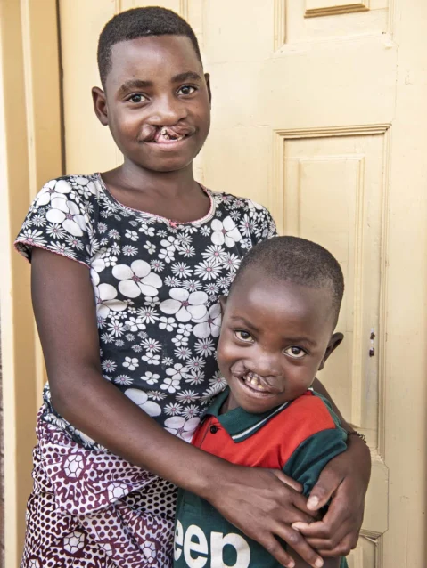 Sister and brother were both born with cleft conditions