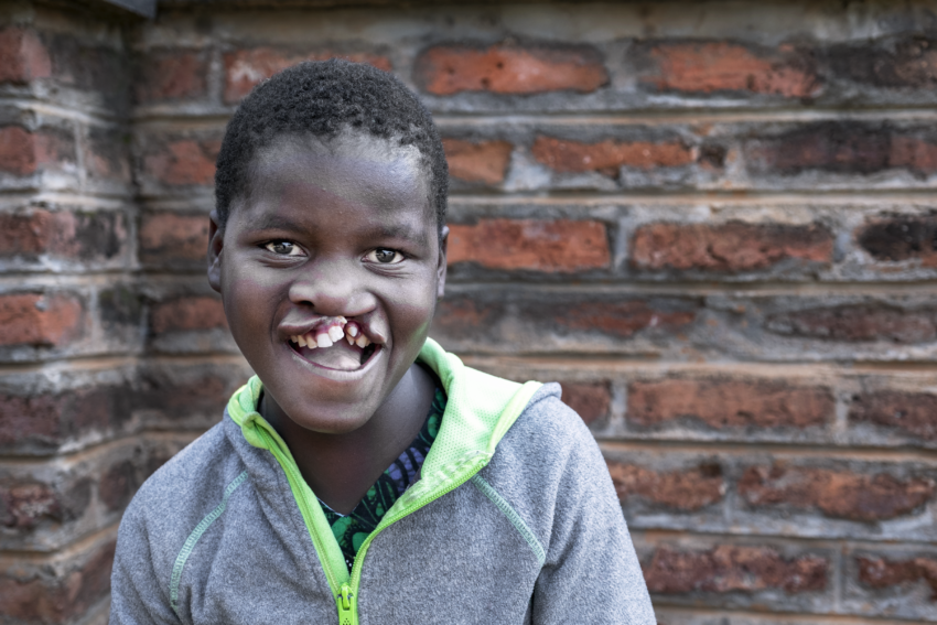 12-year-old girl named Shakira, smiling before her cleft lip surgery in Lilongwe, Malawi.